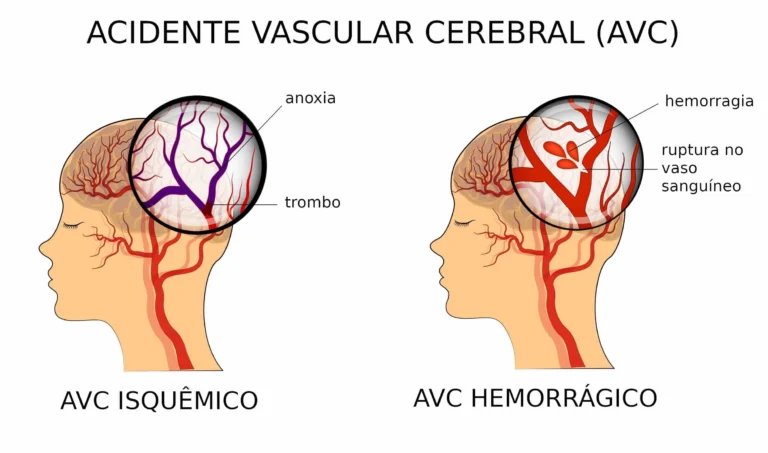 avc em idosos. Ilustração dos tipos de AVC em idosos — isquémico e hemorrágico — com destaque para sintomas e causas.